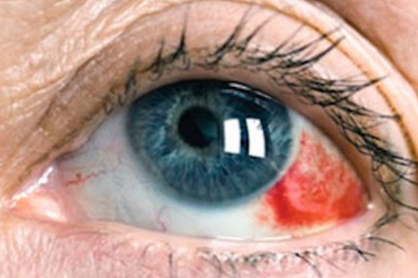 Göz cerrahı, İstanbul göz doktoru,süleyman çataltepe,excimer lazer, Katarakt, göz lazer, süleyman çataltepe, göz doktoru,göz ameliyatı
 Lazer ameliyatı