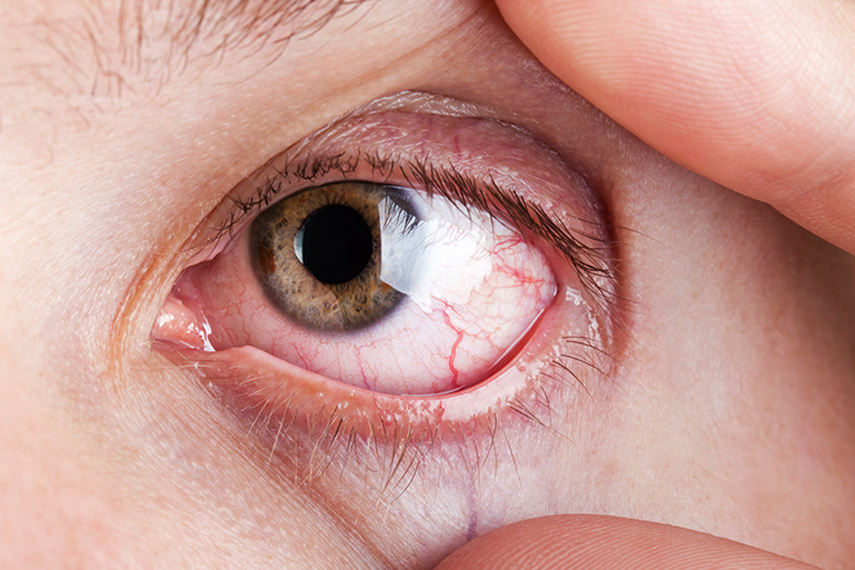 Göz cerrahı, İstanbul göz doktoru,süleyman çataltepe,excimer lazer, Katarakt, göz lazer, süleyman çataltepe, göz doktoru,göz ameliyatı
 Lazer ameliyatı